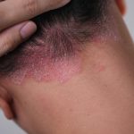 Understanding Scalp Psoriasis: Signs, Symptoms, and Effective Treatments