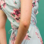 Understanding Atopic Dermatitis and Treatment Options