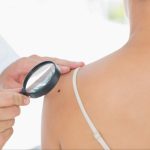 Understanding Melanoma and Its Management